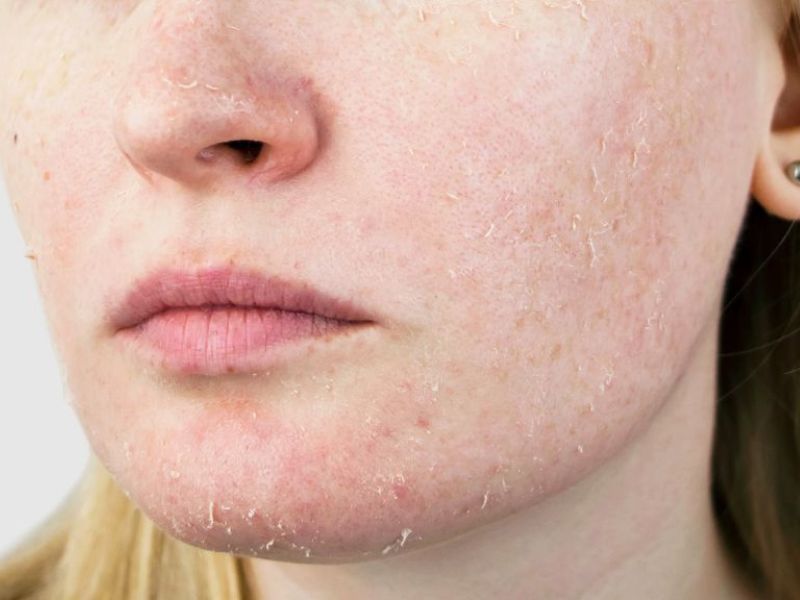 Cara Menjaga Skin Barrier Agar Tetap Kuat