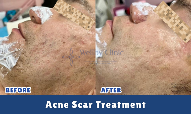 Acne Scar Treatment
