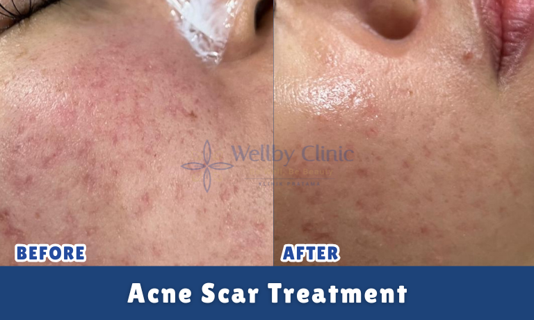 Acne Scar Treatment