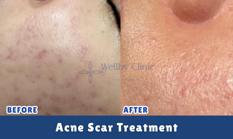 Acne Scar Treatment