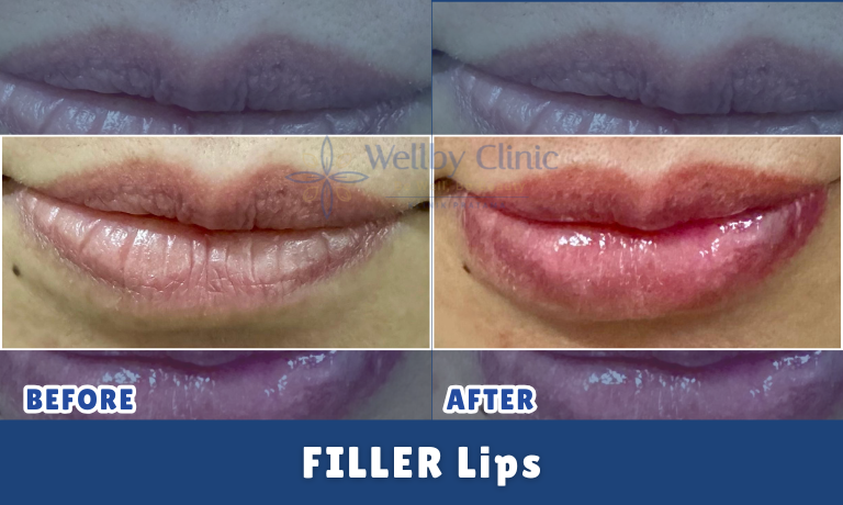 Filler Lips