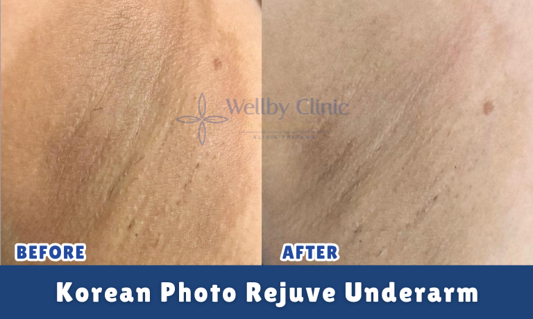 Korean Photo Rejuve Underarm