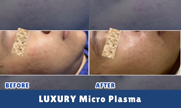 Luxury Micro Plasma
