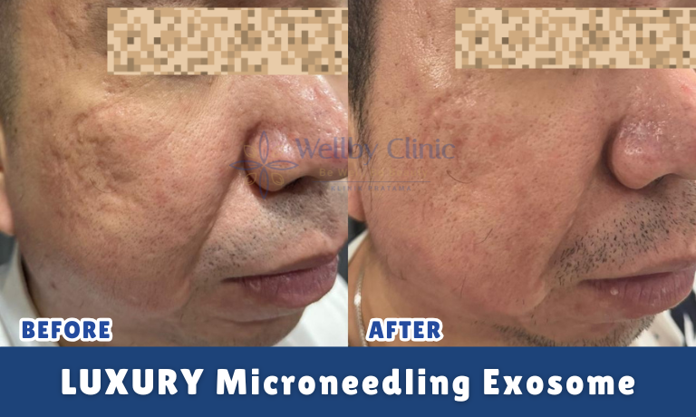 Luxury Microneedling Exosome