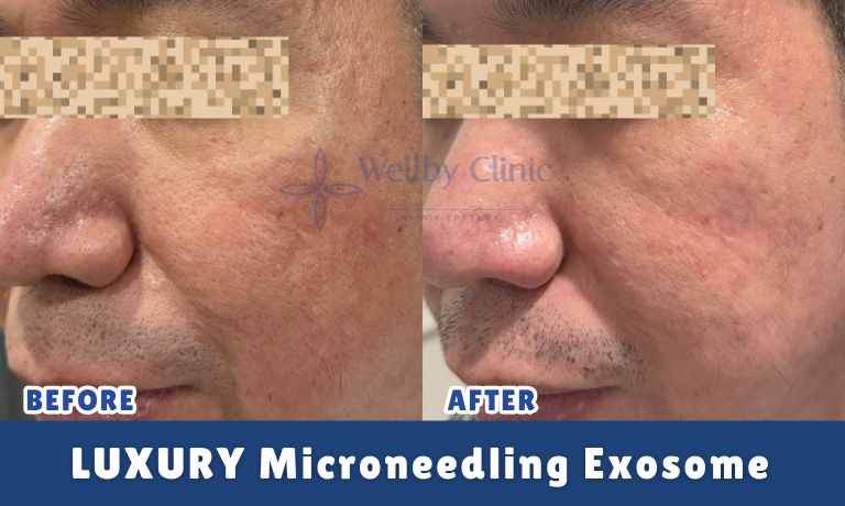 Luxury Microneedling Exosome