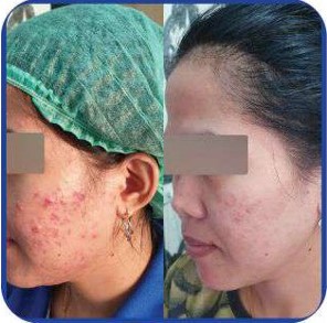Facial Korean Acne Removal