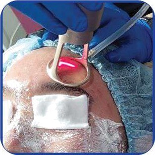 Wellby Fractional CO2 Laser